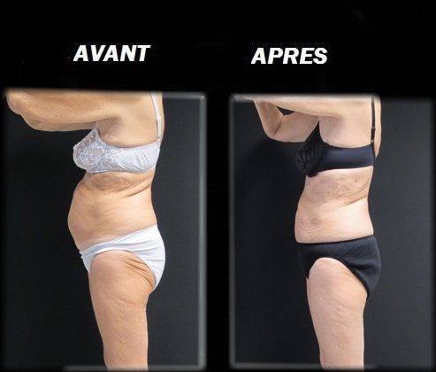 Découvrez la cryolipolyse à caen : sculptez votre silhouette !